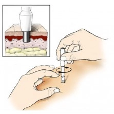 Placchetta sottocutanea per il piercing microdermal di titanio 2 buchi